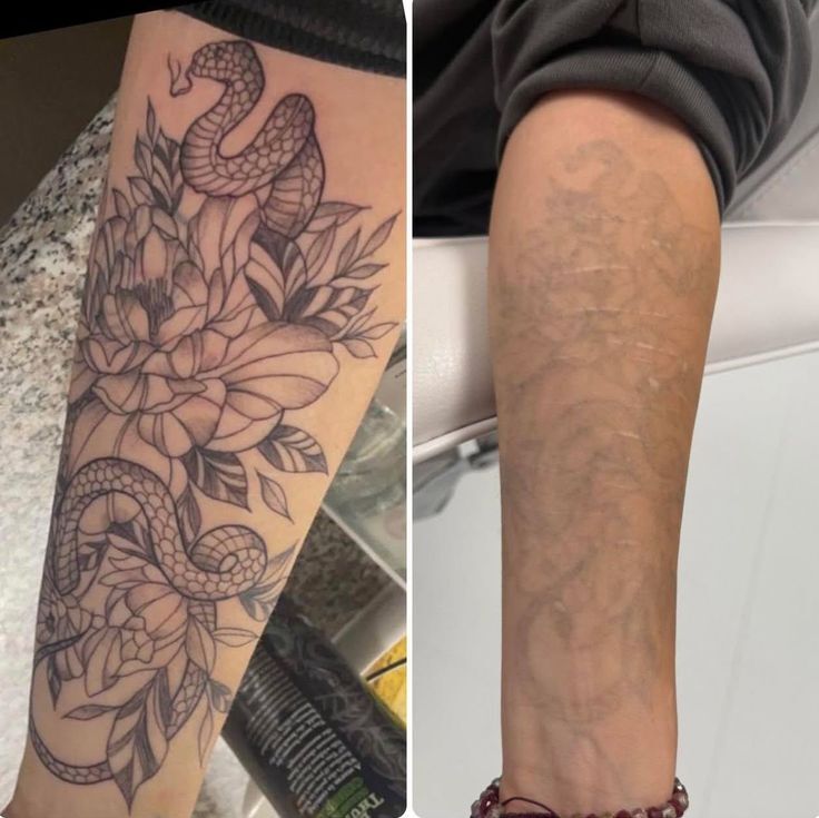 Before and after result of a tattoo removal treatment
