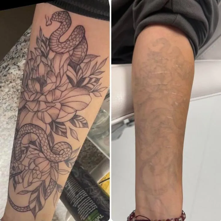 Before and after result of a tattoo removal treatment