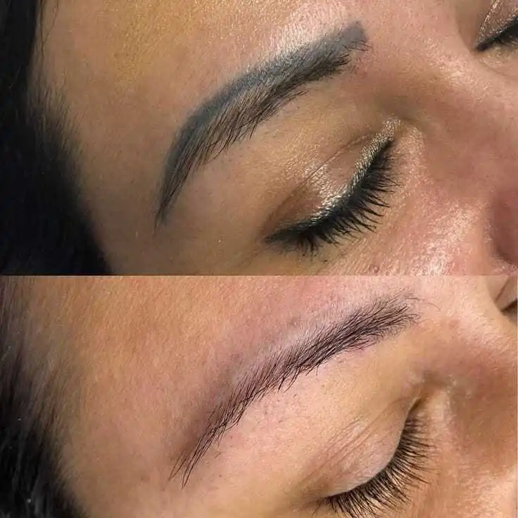 Before and after result of a cosmetic tattoo eyebrow removal treatment