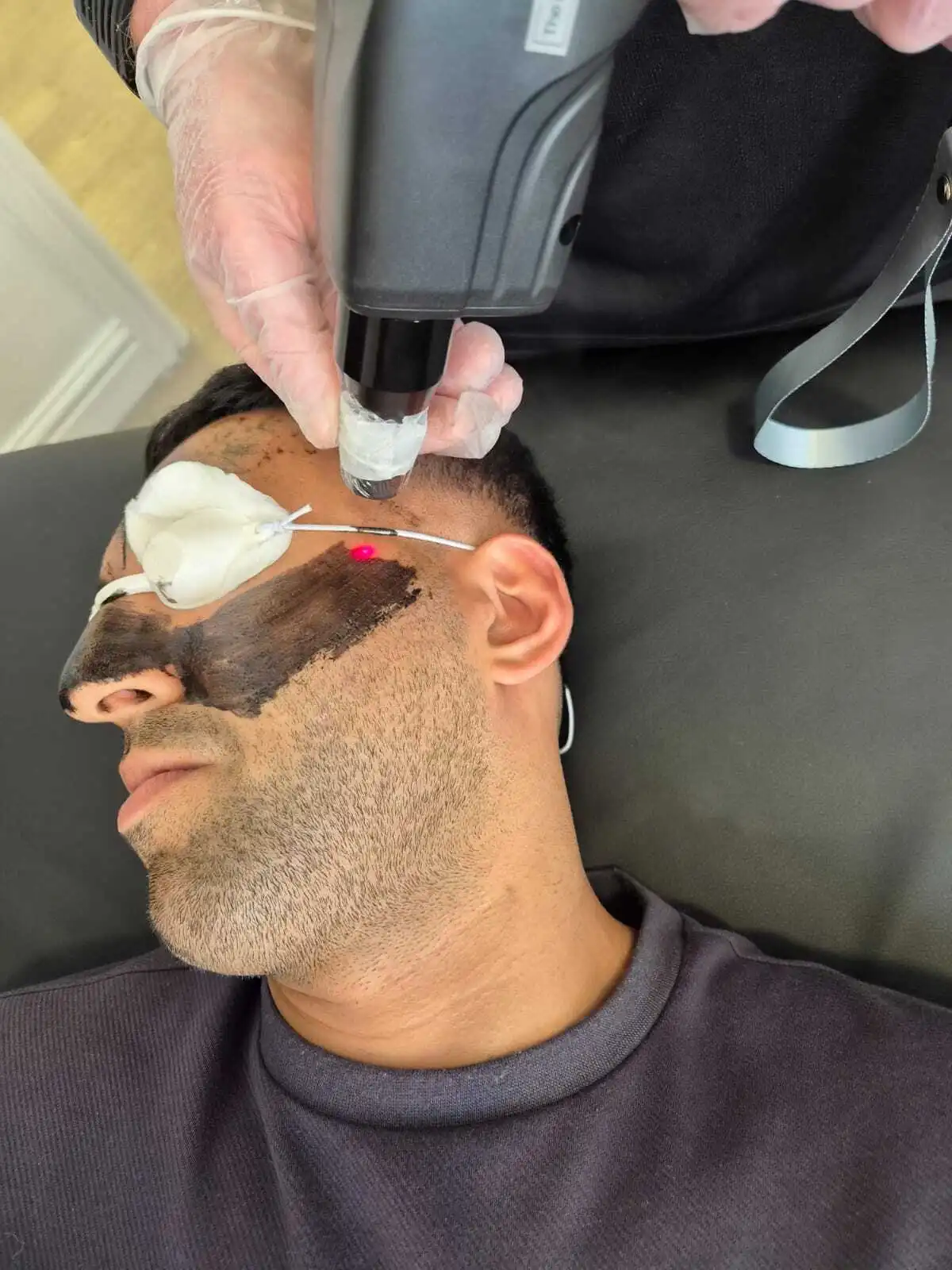 Person receiving a laser carbon facial treatment
