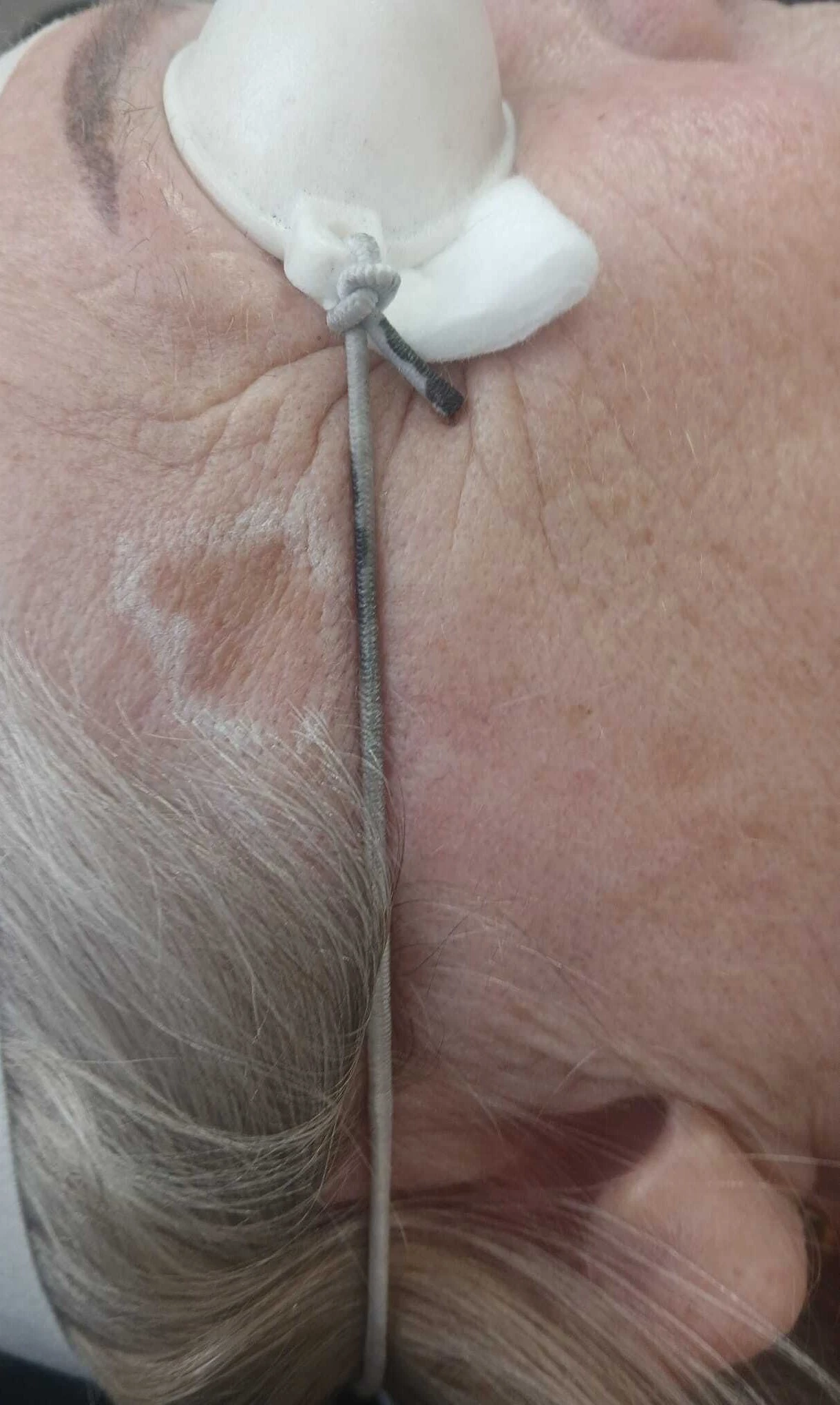 Laser pigmentation removal treatment on facial skin